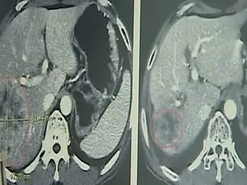 Un virus modificado genéticamente puede combatir el cáncer Un virus modificado genéticamente puede combatir el cáncer