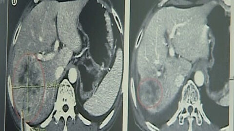  Un virus modificado gen&eacute;ticamente puede combatir el c&aacute;ncer