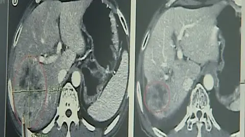 Un virus modificado genéticamente puede combatir el cáncer Un virus modificado genéticamente puede combatir el cáncer