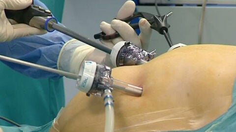 Cirug&iacute;a de bypass g&aacute;strico