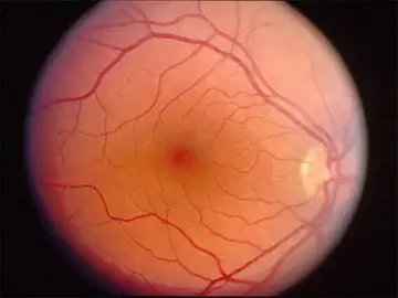 Imagen de la retina Imagen de la retina