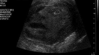 Aparece una cara en la ecografía de un tumor testicular