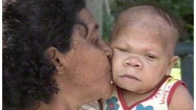Una mujer brasileña tiene 30 años pero el cuerpo de un bebé de nueve meses