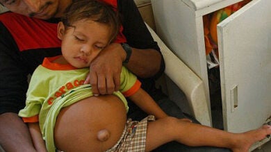 Extraen un gemelo parásito de 25 centímetros del abdomen de un niño peruano