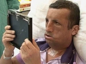 Primer trasplante de cara en Turquía Primer trasplante de cara en Turquía