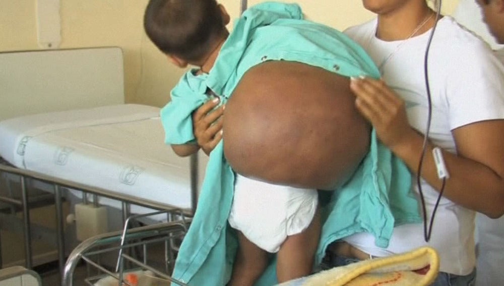 Extirpan un tumor de 15 kilos