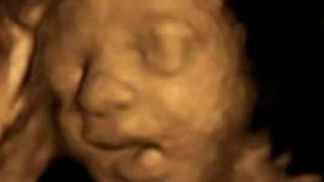 Ecografía de un feto bostezando
