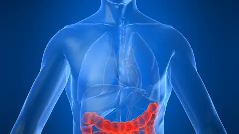 Consiguen frenar la metástasis del cáncer de colon Consiguen frenar la metástasis del cáncer de colon