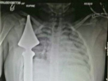 Una valla punzante atravesó el pecho de un niño