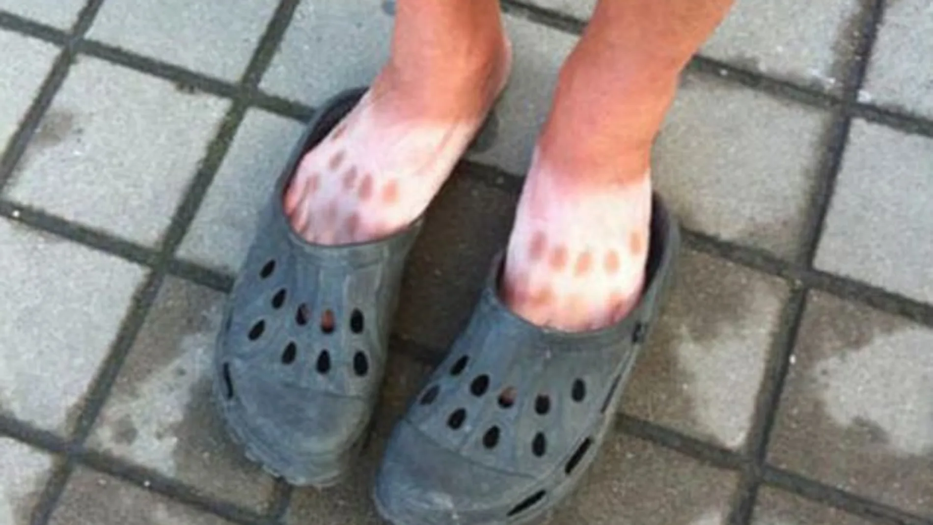 Pies quemados