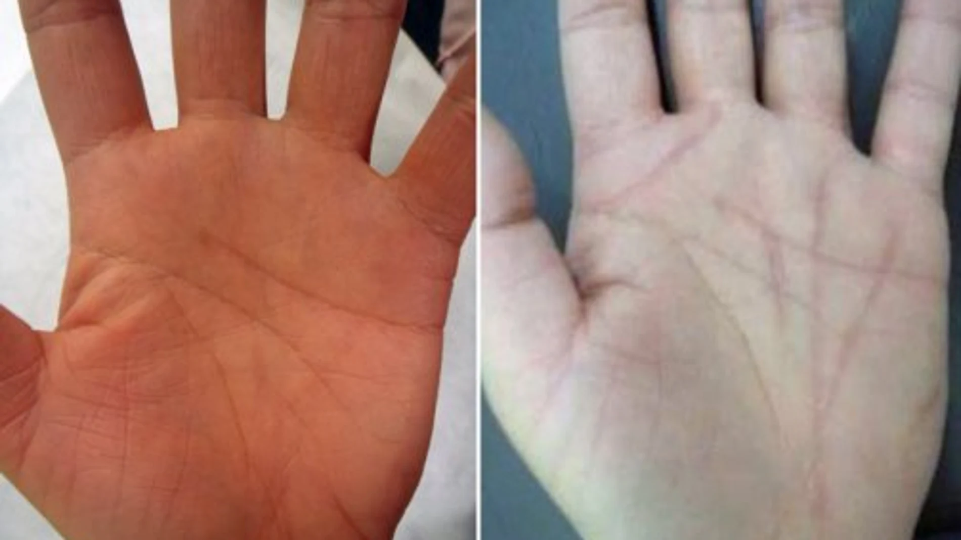 Decenas de japoneses se operan de las palmas de las manos para cambiar su suerte Decenas de japoneses se operan de las palmas de las manos para cambiar su suerte