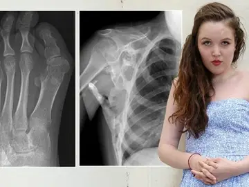 Seanie Nammock junto a unas radiografías de su cuerpo Seanie Nammock junto a unas radiografías de su cuerpo
