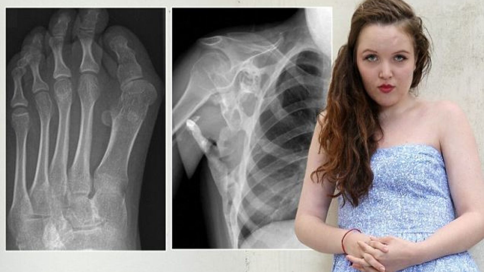Una joven lucha contra una rara enfermedad que transforma sus músculos en huesos