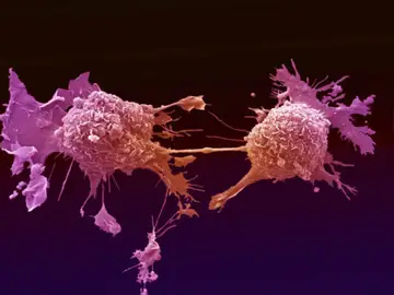 Células de cáncer de pulmón Células de cáncer de pulmón