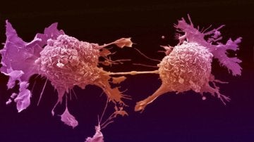 Células de cáncer de pulmón