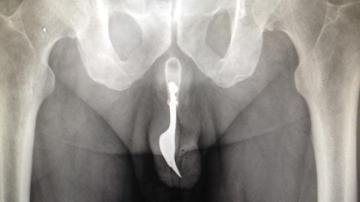 Radiografía de un tenedor en el interior de un australiano de 70 años