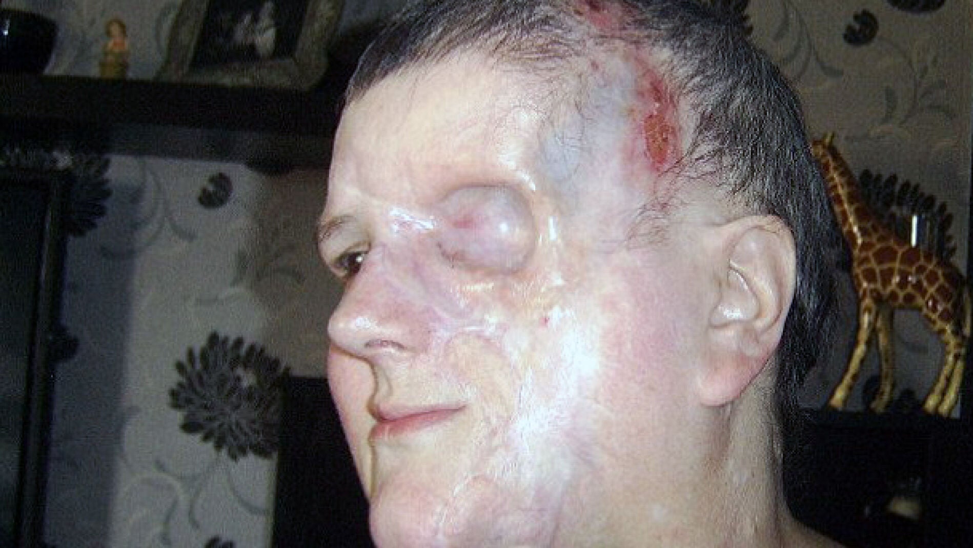 Estado en el que qued&oacute; el rostro de Lou Japp