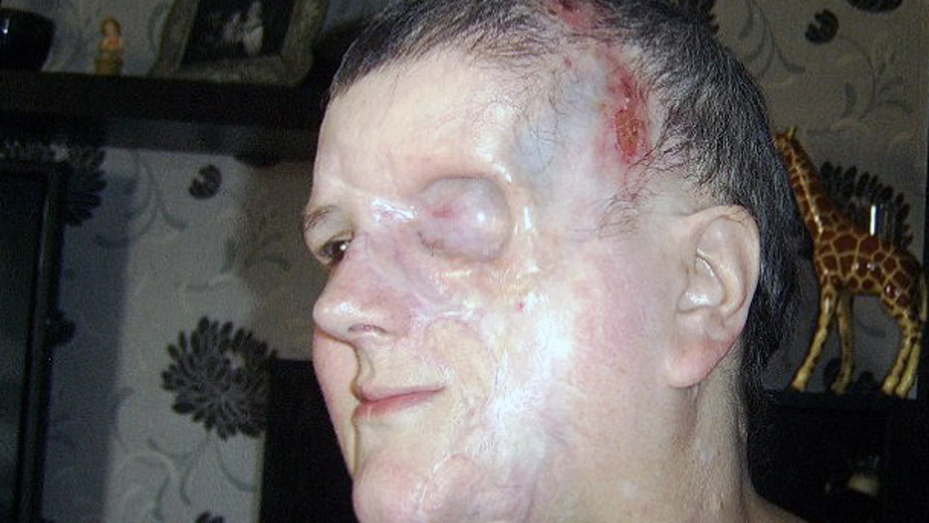 Estado en el que quedó el rostro de Lou Japp Estado en el que quedó el rostro de Lou Japp