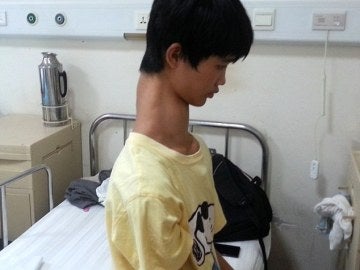 'El chico jirafa' tiene diez vértebras cervicales 'El chico jirafa' tiene diez vértebras cervicales