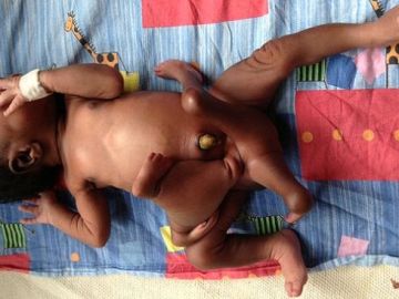 El bebé, antes de enfrentarse a la operación, con cuatro brazos y cuatro piernas