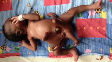 El bebé, antes de enfrentarse a la operación, con cuatro brazos y cuatro piernas