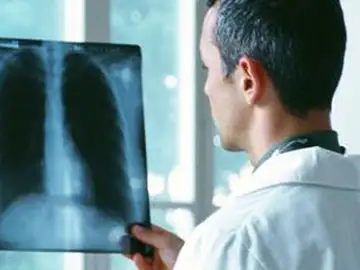 Progresos médicos para combatir el cáncer de pulmón Progresos médicos para combatir el cáncer de pulmón