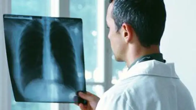 Progresos médicos para combatir el cáncer de pulmón Progresos médicos para combatir el cáncer de pulmón