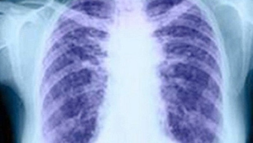 El cáncer de pulmón