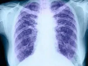 El cáncer de pulmón El cáncer de pulmón