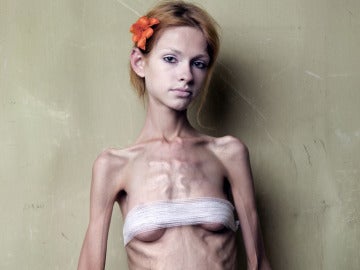 Imagen de una joven que sufre anorexia.