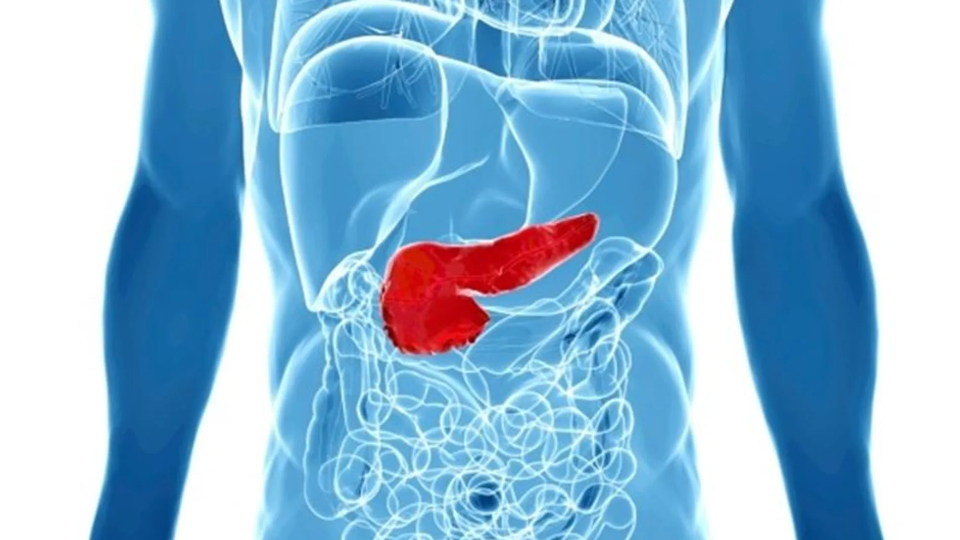 Gráfico de cáncer de páncreas Gráfico de cáncer de páncreas