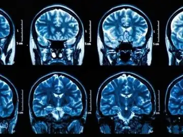 Tumores cerebrales Tumores cerebrales
