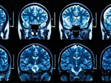 Tumores cerebrales Tumores cerebrales