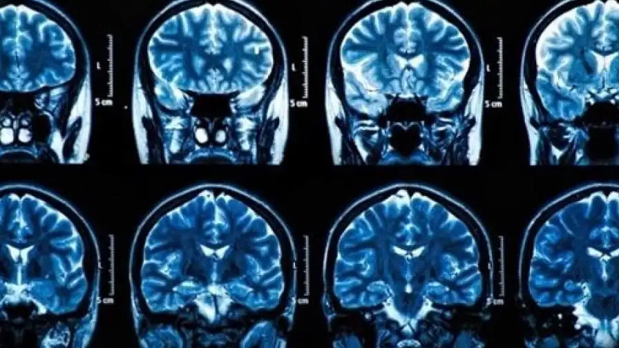 Tumores cerebrales Tumores cerebrales
