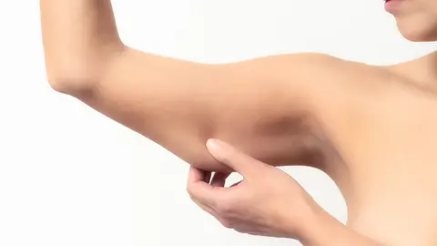 Flacidez en los brazos Flacidez en los brazos