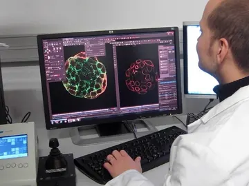 Una huella de la metástasis puede identificar el origen del cáncer Una huella de la metástasis puede identificar el origen del cáncer