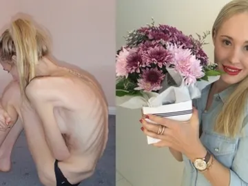 Fotos de Gema Walker antes y después de padecer anorexia Fotos de Gema Walker antes y después de padecer anorexia