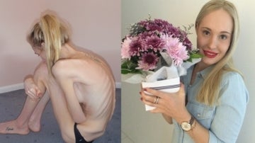Fotos de Gema Walker antes y después de padecer anorexia