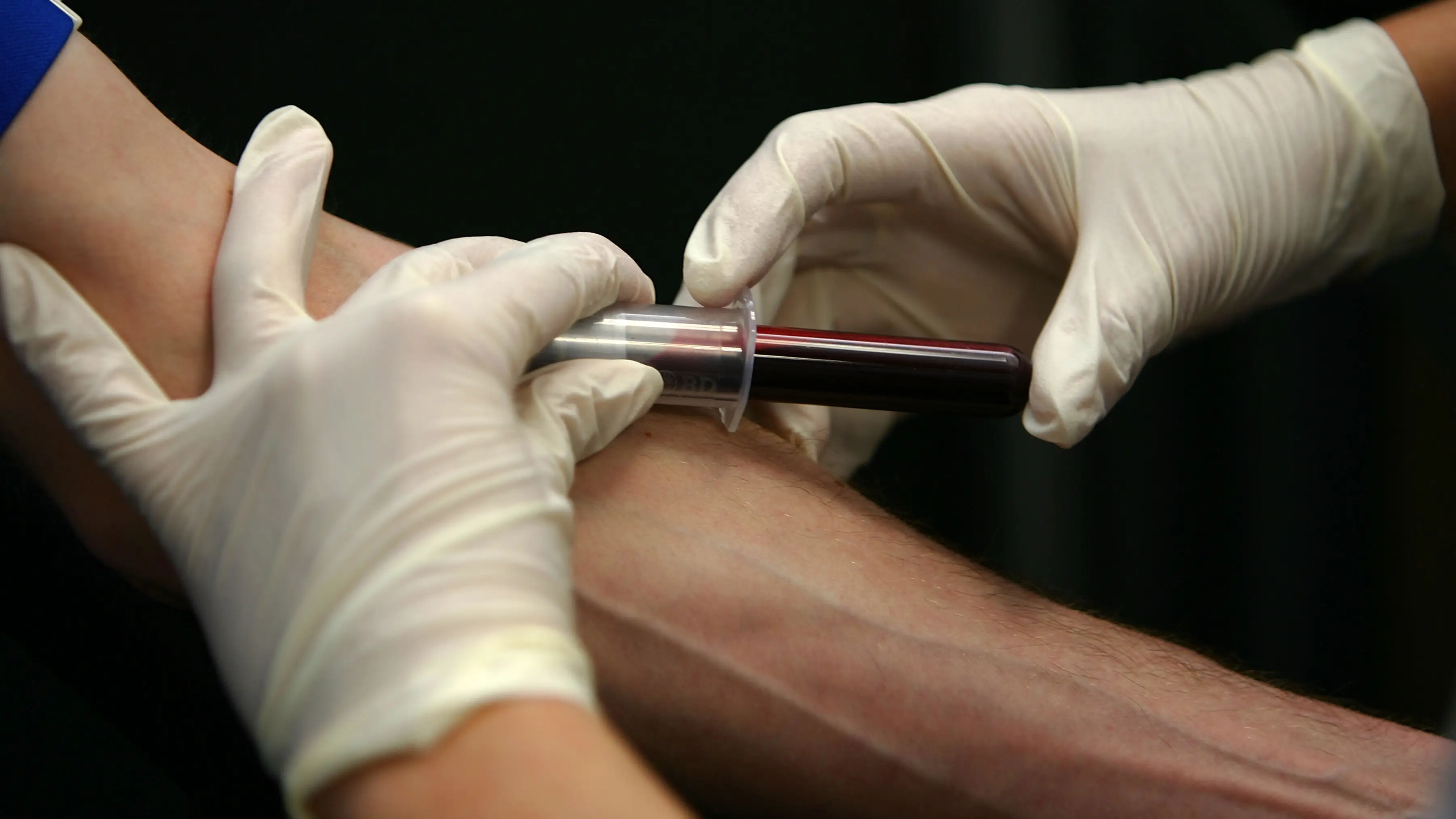 Desarrollan en Estados Unidos el primer dispositivo de extracción de sangre sin agujas Desarrollan en Estados Unidos el primer dispositivo de extracción de sangre sin agujas