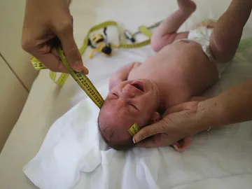 Dos casos de microencefalia relacionados con el Zika Dos casos de microencefalia relacionados con el Zika