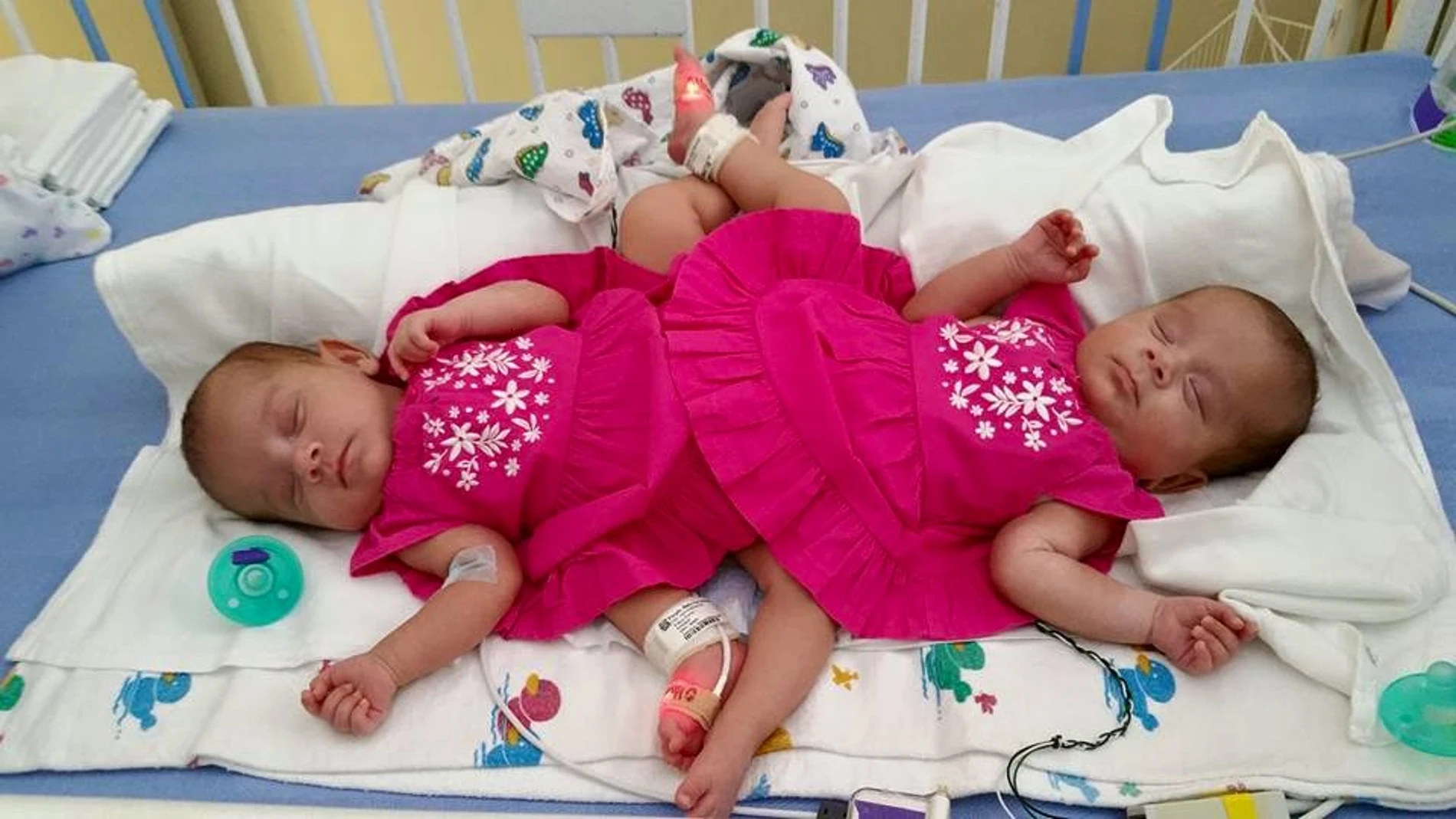 Las dos hermanas siamesas del grupo de trillizas Las dos hermanas siamesas del grupo de trillizas
