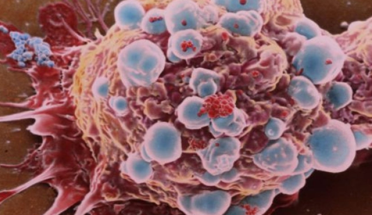 C&eacute;lula cancerosa de c&aacute;ncer de mama