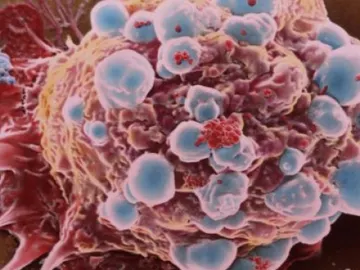 Célula cancerosa de cáncer de mama Célula cancerosa de cáncer de mama