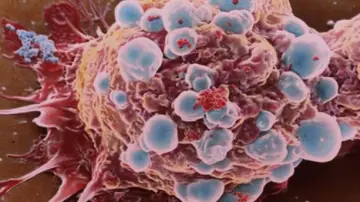 Célula cancerosa de cáncer de mama Célula cancerosa de cáncer de mama