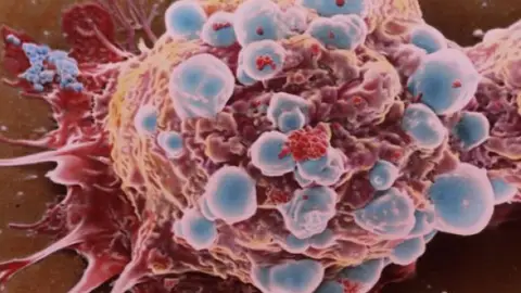 Célula cancerosa de cáncer de mama Célula cancerosa de cáncer de mama