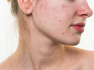 ¿Hay comidas que provocan acné? Pues, puede ser...