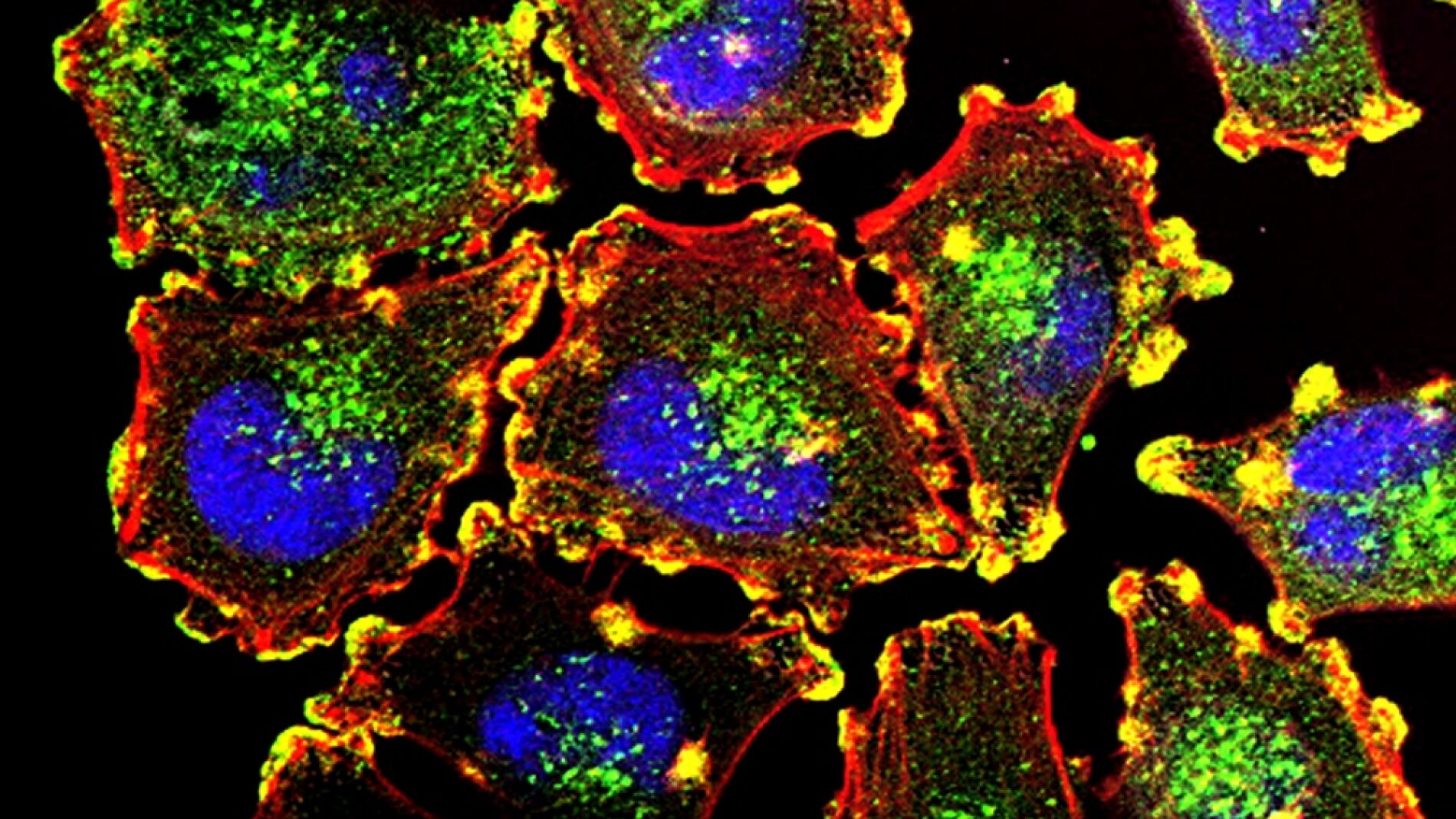 Imagen de c&eacute;lulas cancerosas