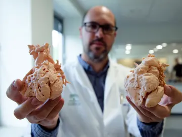 Corazones impresos a tamaño real en 3D para planificar la intervención en niños Corazones impresos a tamaño real en 3D para planificar la intervención en niños