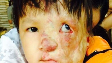 Una mujer de Alabama pide ayuda para que una niña vietnamita con un tumor en la cara pueda ser operada