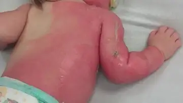 Quemaduras de segundo grado en un bebé de nueve meses Quemaduras de segundo grado en un bebé de nueve meses